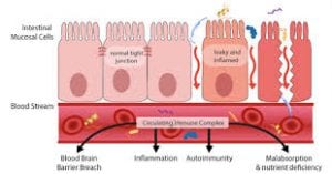 leaky-gut